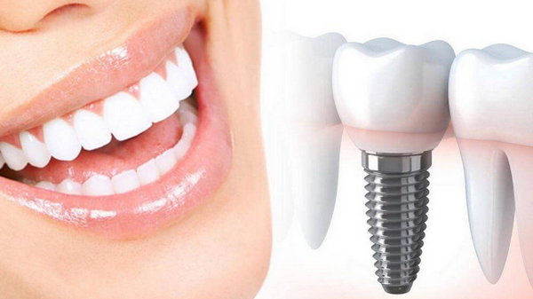 Что такое одномоментная имплантация зубов?