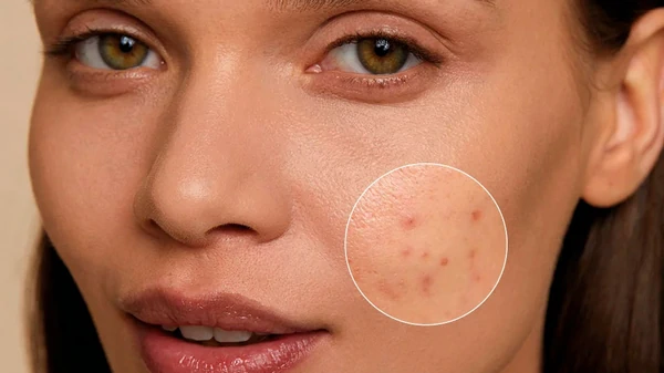 Как лечить проблемную кожу лица
