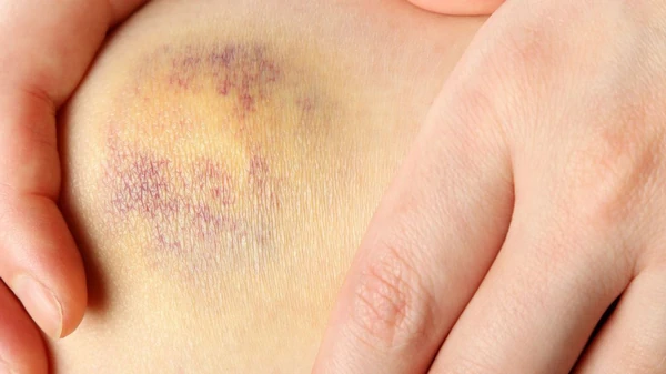 Почему после массажа появляются синяки