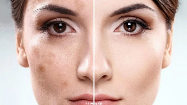 Как избавиться от пигментных пятен