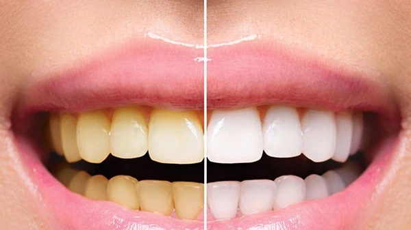 Как снять зубной налёт