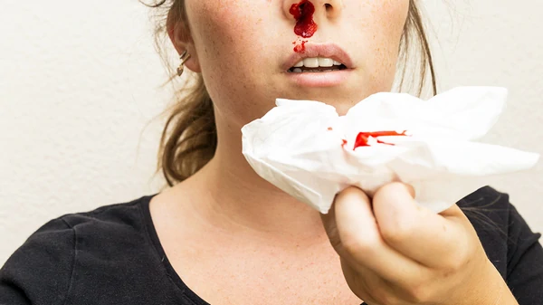 Как быстро остановить кровь из носа