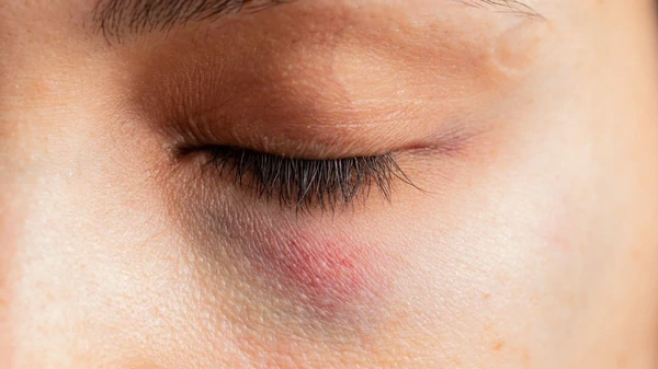 Синяки и отеки после блефаропластики: почему появляются и как с ними справи...