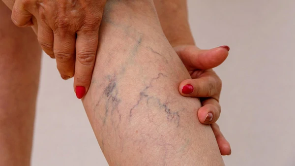 Как определить тромбоз