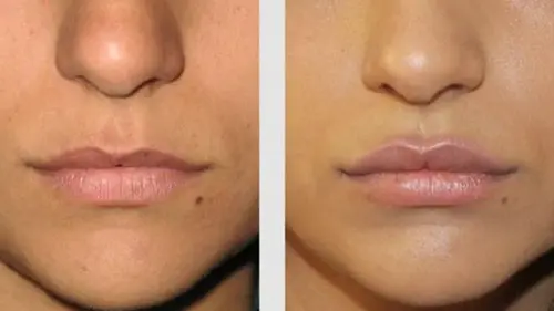 Корнер-лифт — это небольшое, но все-таки хирургическое вмешательство