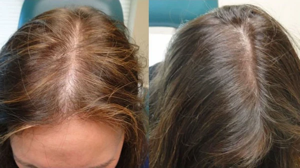 Помогут 3 ложки кофе: что нужно сделать, чтобы волосы перестали выпада...