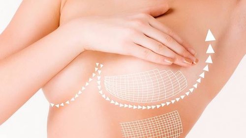 Хирургическая подтяжка груди: что следует знать
