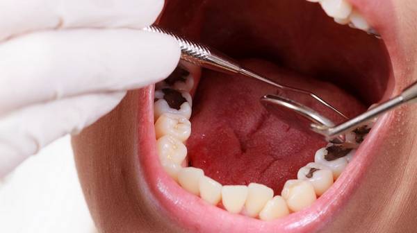 Все что нужно знать о восстановлении разрушенных зубов
